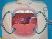 Operate Now: Tonsil Surgery